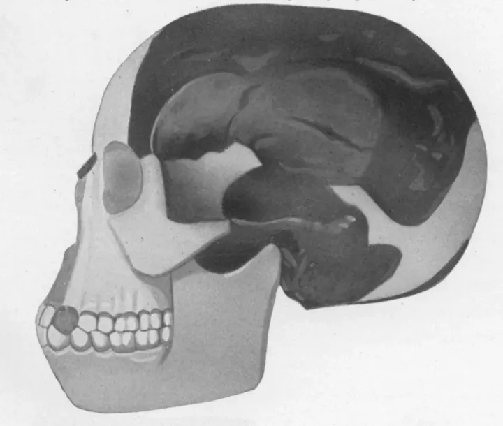 Skull reconstruction